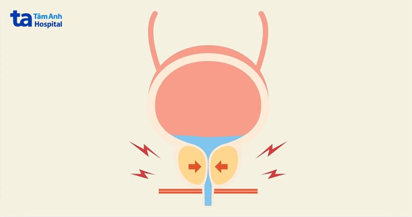 bí tiểu ở nam giới là tình trạng không có khả năng làm trống bàng quang