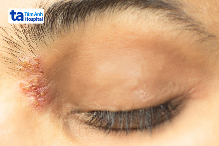 bị zona ở mắt