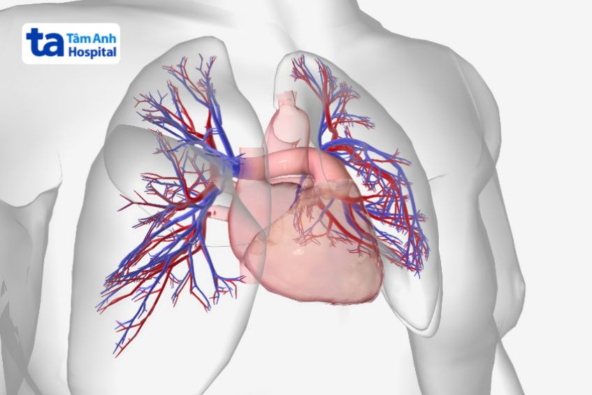 Biến chứng tăng áp động mạch phổi do bệnh tim bẩm sinh