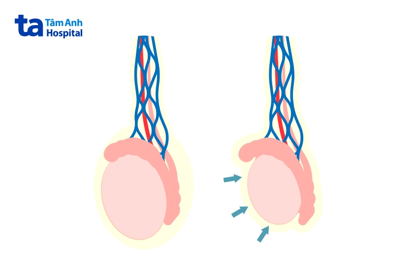 biến chứng teo tinh hoàn sau khi mắc quai bị