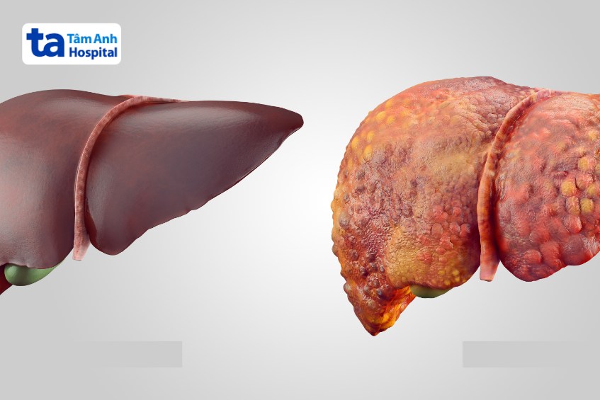 biến chứng virus viêm gan b