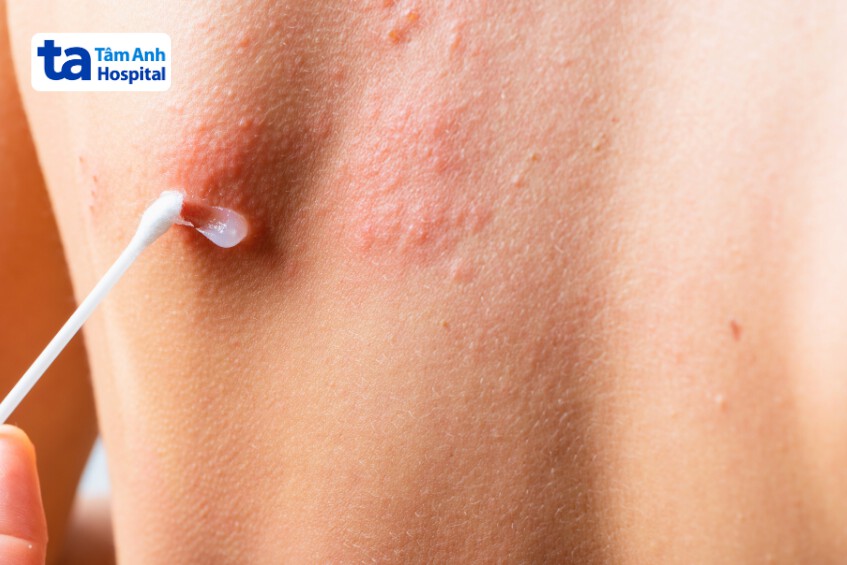 bôi thuốc điều trị zona