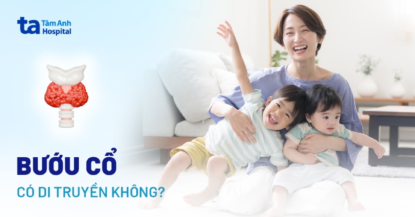 bướu cổ có di truyền không