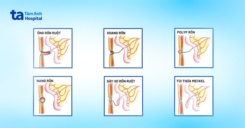 các hình thái tồn tại ống rốn tràng thường gặp