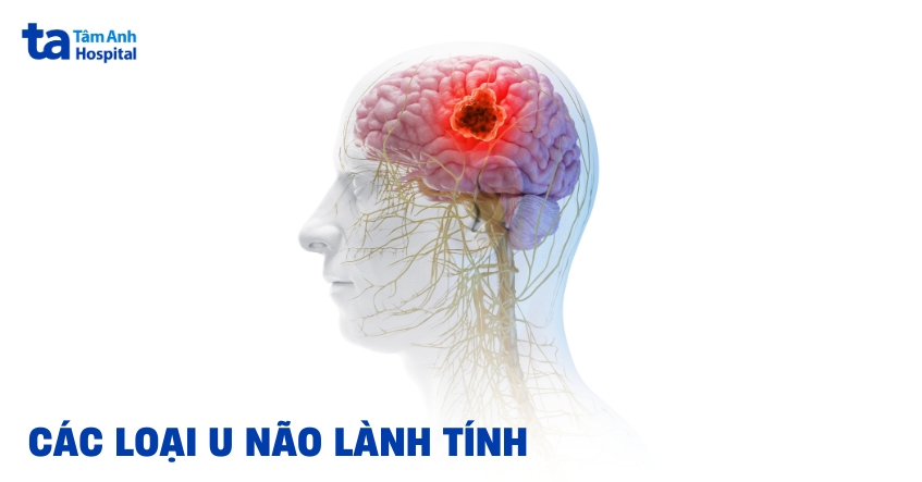 Các loại u não lành tính phổ biến hiện nay và tiên lượng