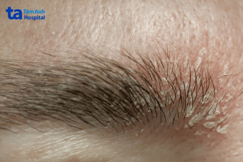 viêm da tiết bã xuất hiện tại lông mày