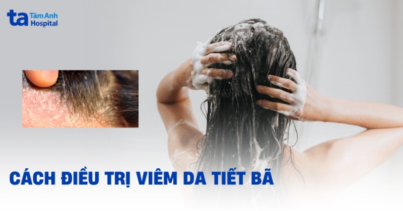 2 cách điều trị viêm da tiết bã nhờn tại nhà và lưu ý cần biết