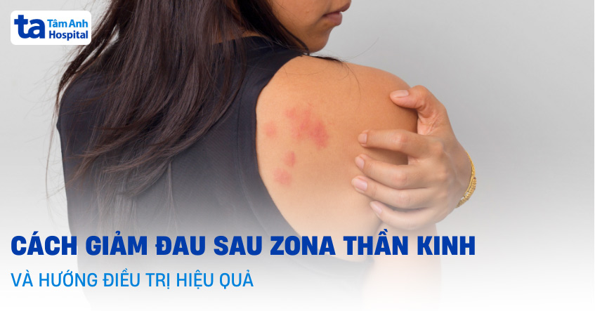 3 cách giảm đau sau zona thần kinh và hướng điều trị hiệu quả
