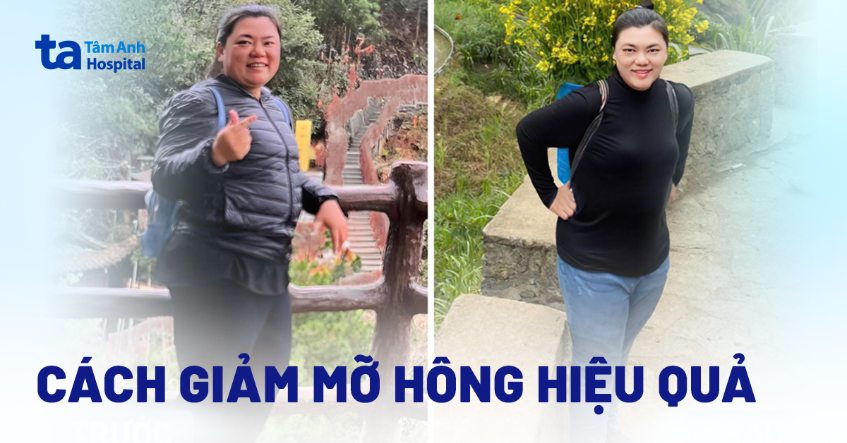 Làm sao để giảm mỡ hông 2 bên hiệu quả, sớm lấy lại vóc dáng