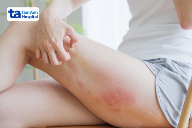 mặc đồ rộng và thoáng để giảm ngứa