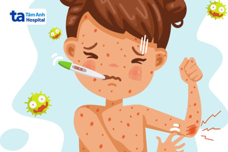 trẻ bị sốt phát ban trên da gây ngứa