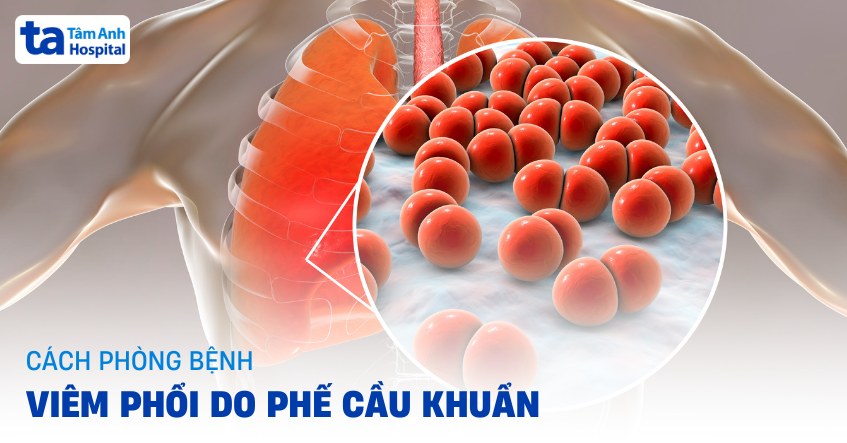 4 cách phòng bệnh viêm phổi do phế cầu khuẩn hiệu quả, tham khảo