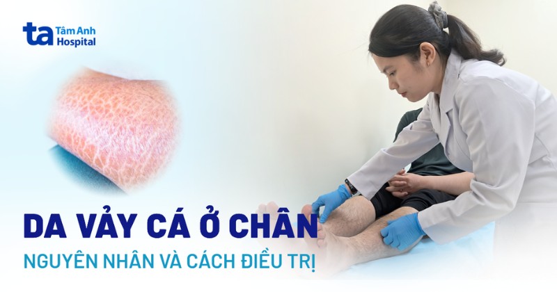 4 cách trị da vảy cá ở chân tại nhà ngăn chặn triệu chứng khó chịu