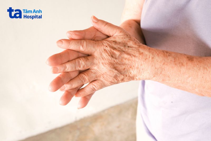 tay là vùng da dễ nổi đồi mồi