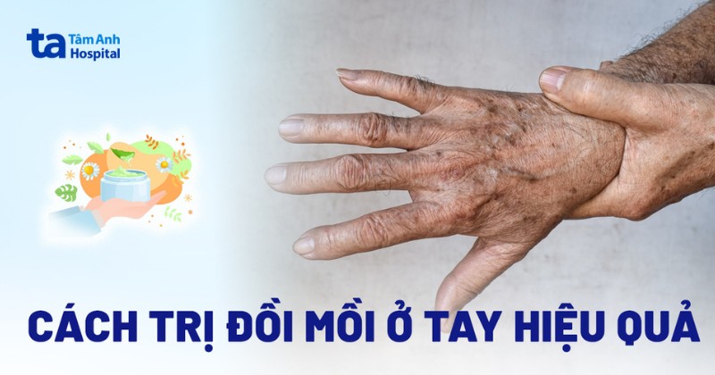 7 cách trị đồi mồi ở tay tại nhà hiệu quả cao có thể thực hiện