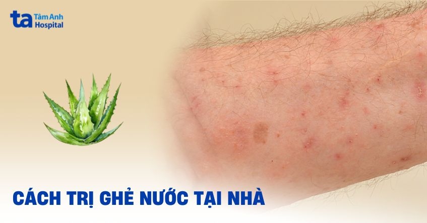 14 cách trị ghẻ nước tại nhà an toàn, hiệu quả nhanh tận gốc
