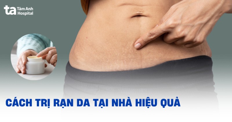 10 cách trị rạn da tại nhà giúp xóa hết vết rạn nứt hiệu quả
