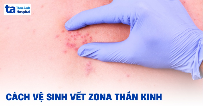 6 cách vệ sinh vết zona thần kinh đúng để tránh nhiễm trùng