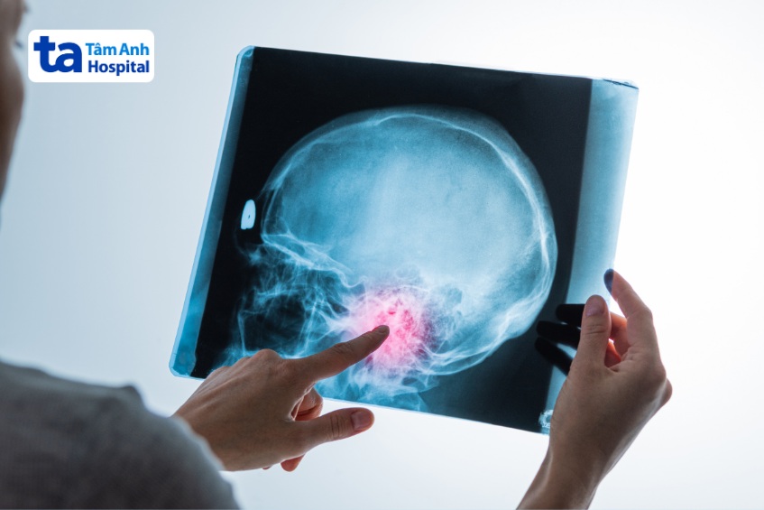 cân nhắc phương pháp điều trị u não lành tính