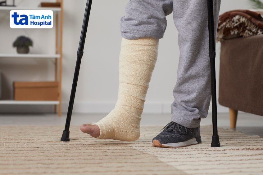 can thiệp sớm giúp xương cẳng chân nhanh lành