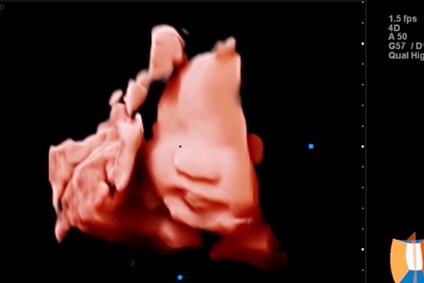 case nguyễn ngọc khánh vy lp ivf