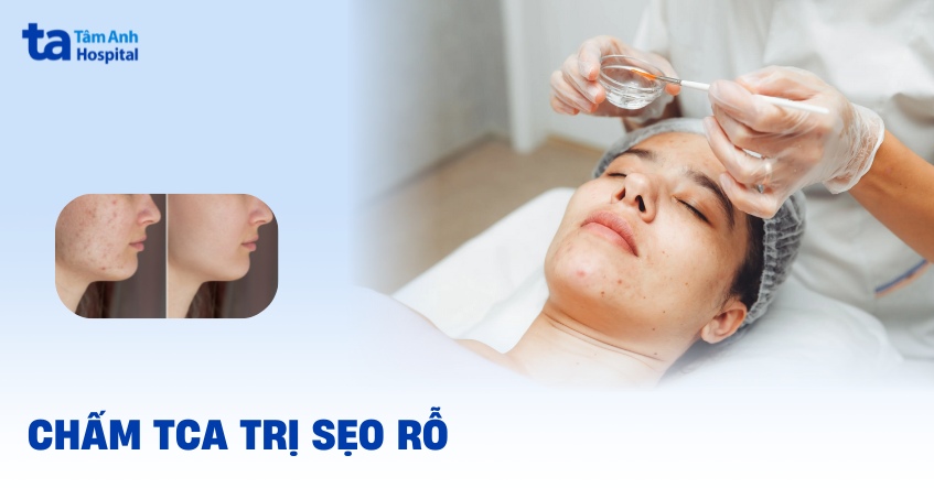 Chấm TCA trị sẹo rỗ có hiệu quả không? Ưu và nhược điểm