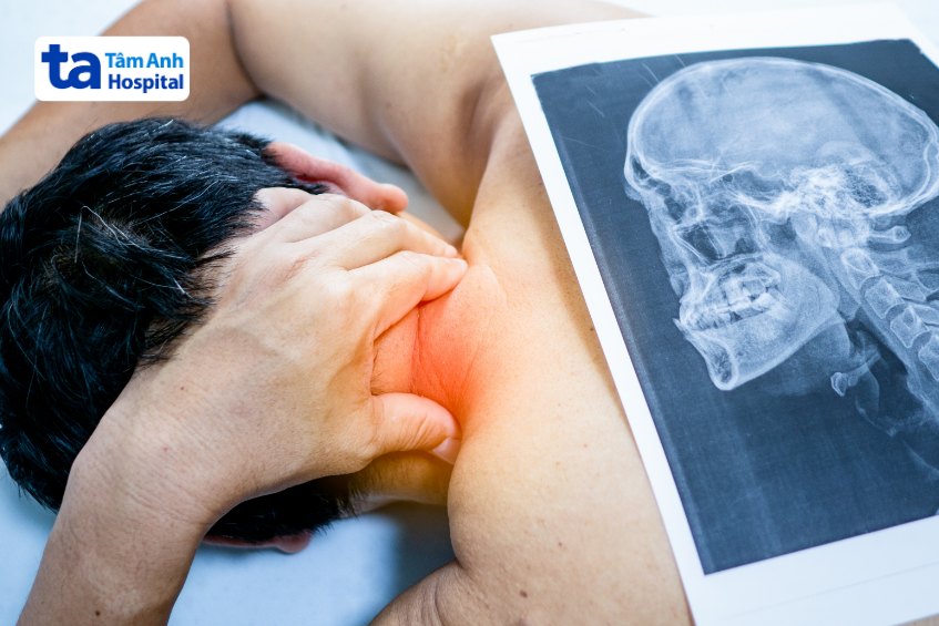 chẩn đoán hình ảnh dây thần kinh số 11