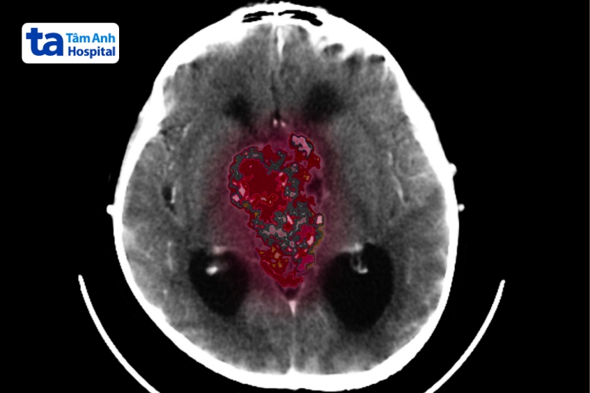 chẩn đoán hình ảnh u màng não thất