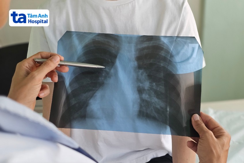 chẩn đoán viêm phế quản do phế cầu