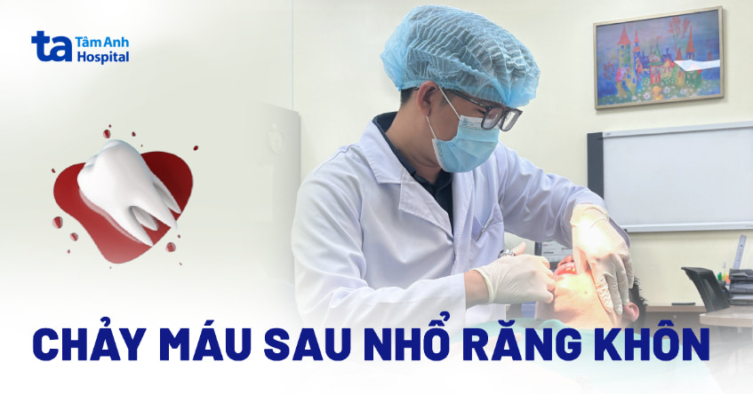 Chảy máu sau nhổ răng khôn bao lâu thì hết? Làm sao để cầm máu?