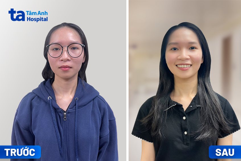 chị nguyệt trước và sau khi mổ cận