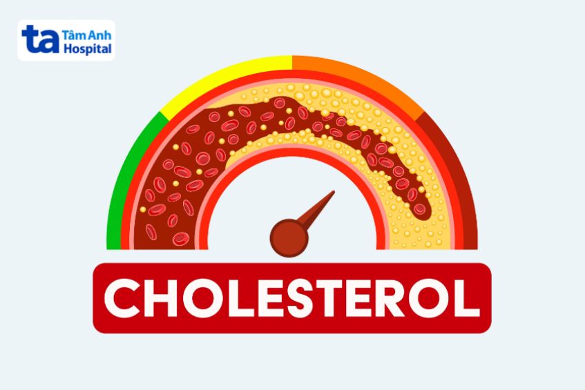 Cholesterol cao gây tích tụ mảng xơ vữa