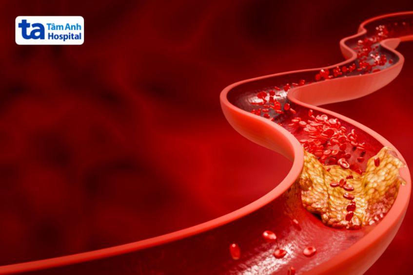 Cholesterol cao làm tăng nguy cơ hình thành mảng xơ vữa trong động mạch