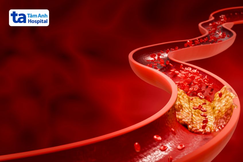 Cholesterol dư thừa tạo thành mảng xơ vữa bám trong lòng mạch