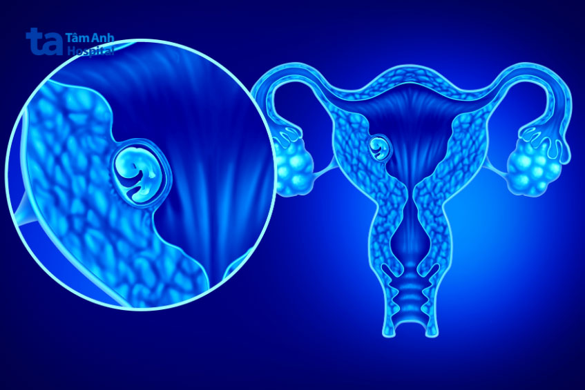 Niêm mạc tử cung là nơi phôi thai di chuyển đến bám vào làm tổ