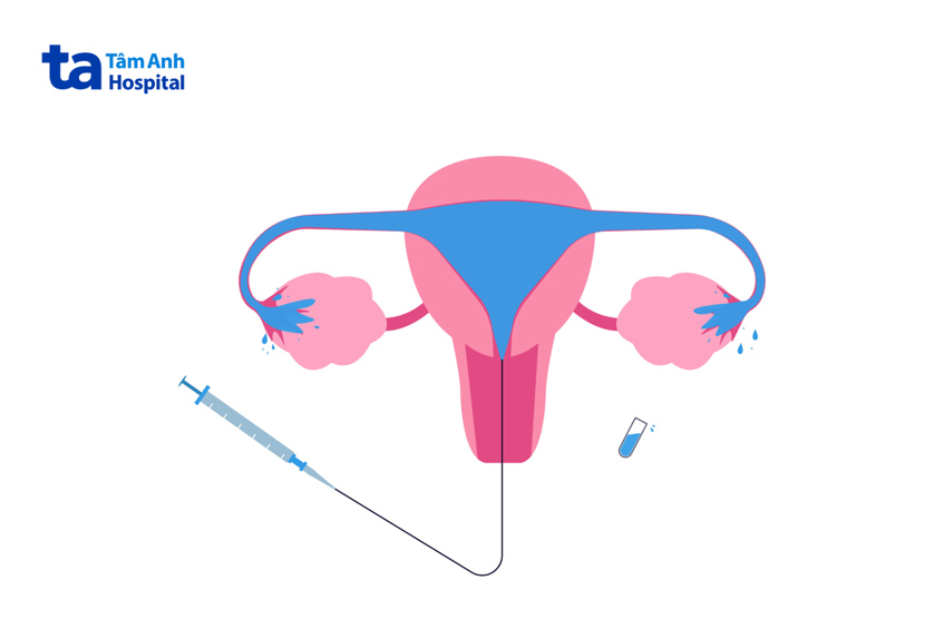 chụp hsg cho trường hợp khó có thai