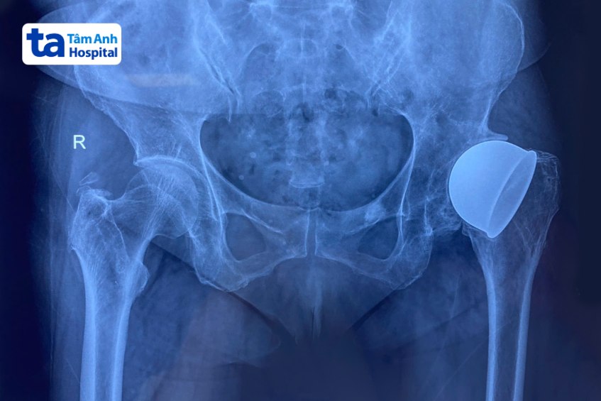 chụp x quang khớp háng bà hà