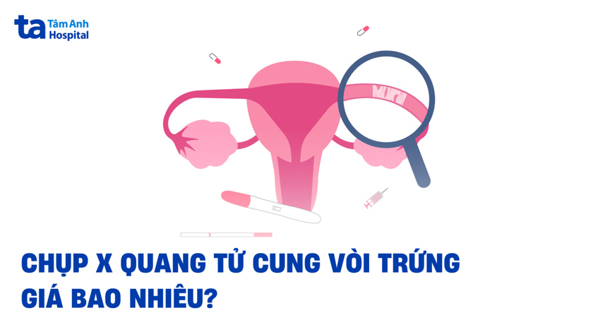 Chụp X quang tử cung vòi trứng giá bao nhiêu? Có đắt không?
