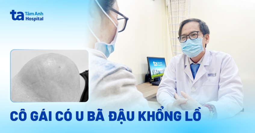 Cô gái có u bã đậu khổng lồ