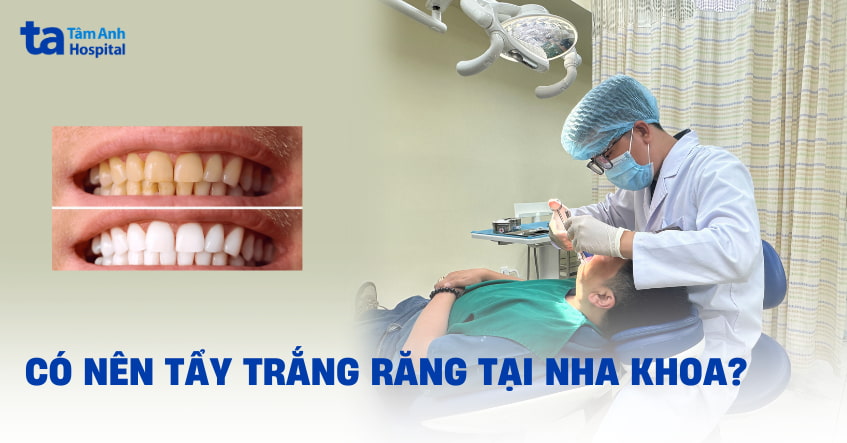Có nên tẩy trắng răng tại nha khoa? So sánh với tẩy trắng tại nhà