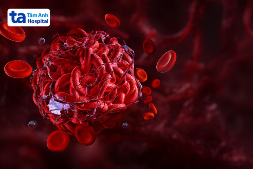 Người bệnh có nguy cơ hình thành cục máu đông trên bề mặt van tim mới