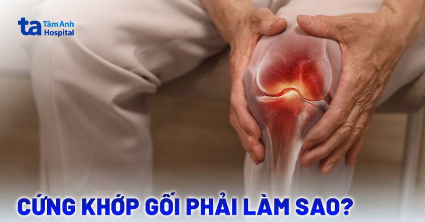 Cứng khớp gối phải làm sao? Cách cải thiện bệnh tại nhà hiệu quả