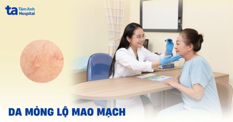 Da mỏng lộ mao mạch là gì? Nguyên nhân và cách chữa trị