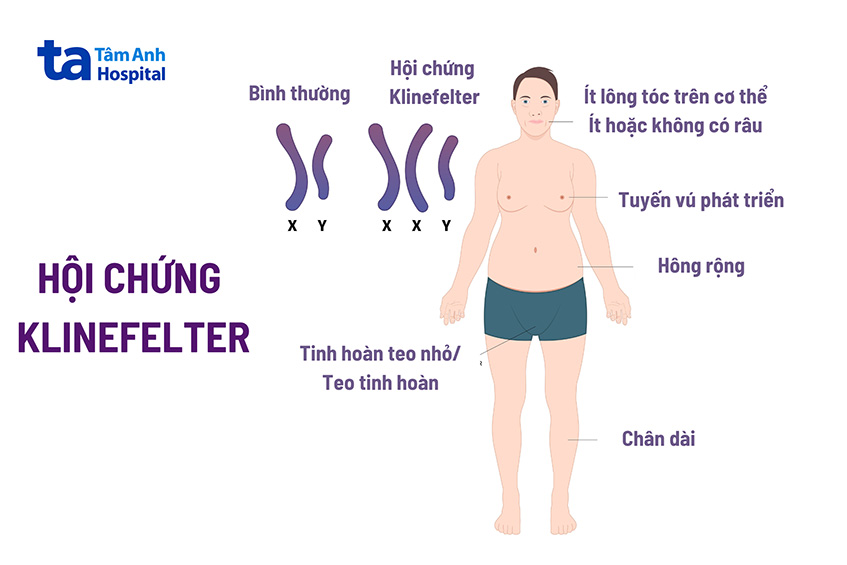 Hội chứng Klinefelter có chữa được không? phương pháp điều trị bệnh?