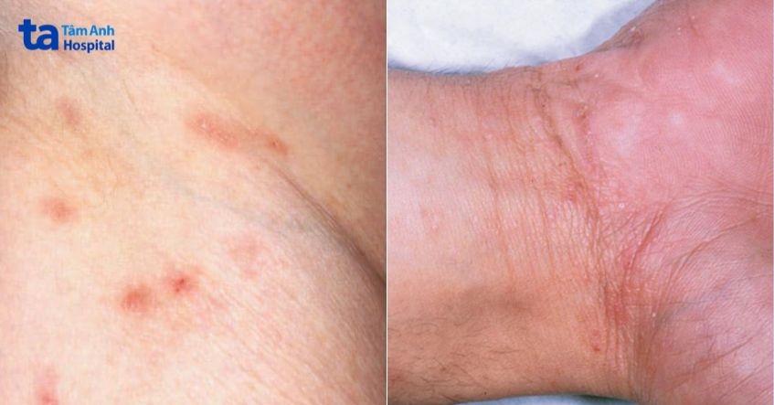 dấu hiệu bệnh ghẻ ruồi