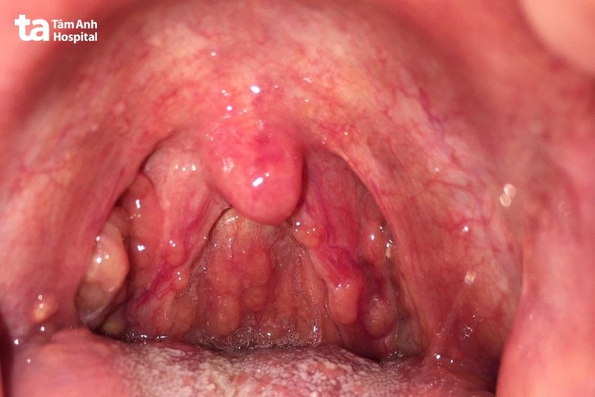 dấu hiệu viêm họng hạt mạn