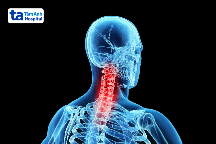 Đau vai gáy không quay được cổ do chấn thương