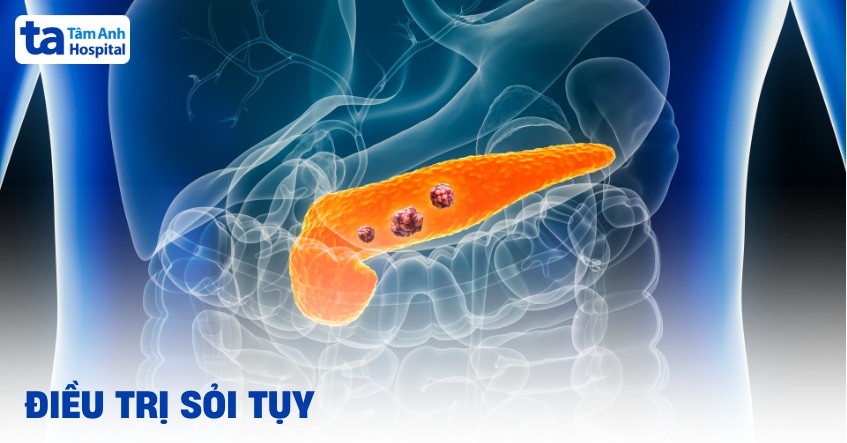 điều trị sỏi tụy