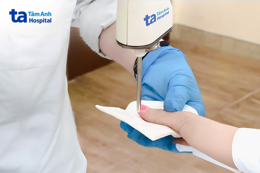 điều trị u cuộn mạch bằng laser 4d dynamic