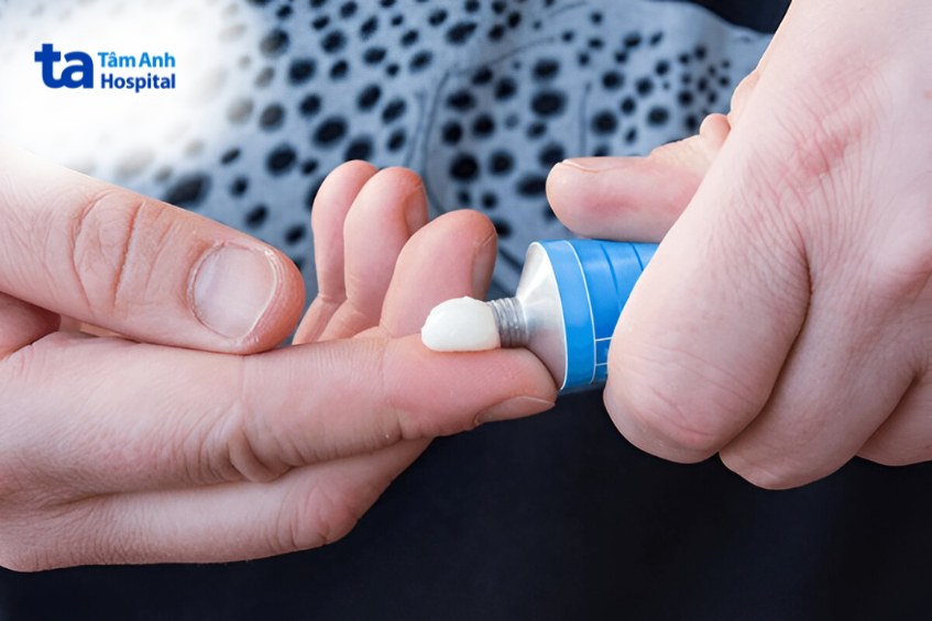 điều trị vảy nến thể giọt bằng thuốc bôi